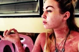 Meet the woman facing psoriasis head on | Challenging body image perceptions (F)