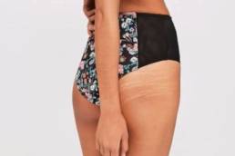 missguided stretchmarks featured